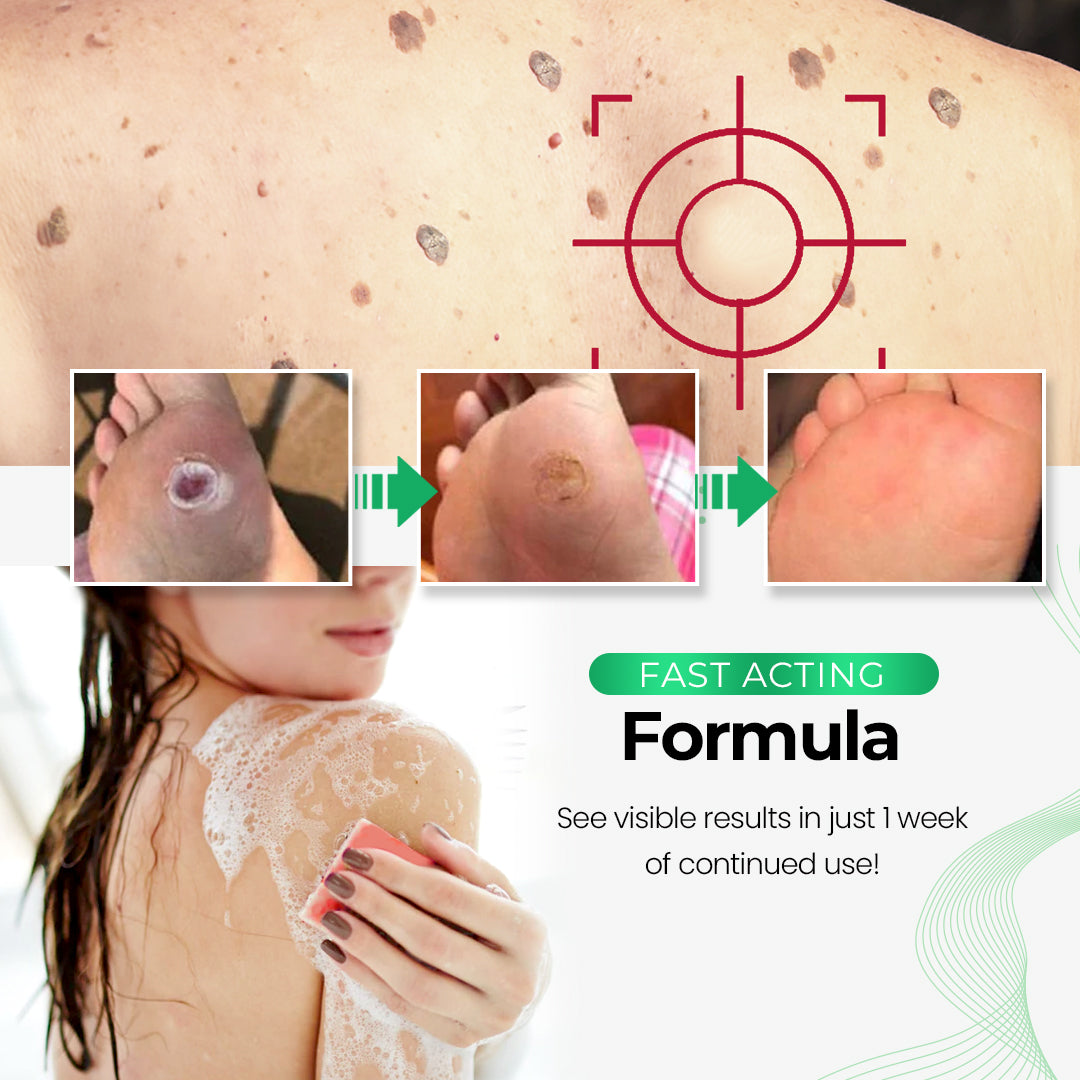 SmooothSkin™ Wart Eliminator Soap