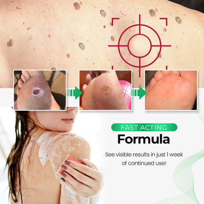 SmooothSkin™ Wart Eliminator Soap