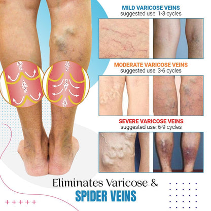 ZAKDAVI™ Varicose Veins Treatment Spray